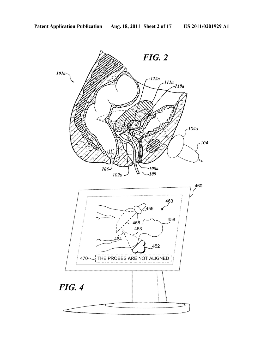 METHOD FOR USING HIGH INTENSITY FOCUSED ULTRASOUND - diagram, schematic, and image 03