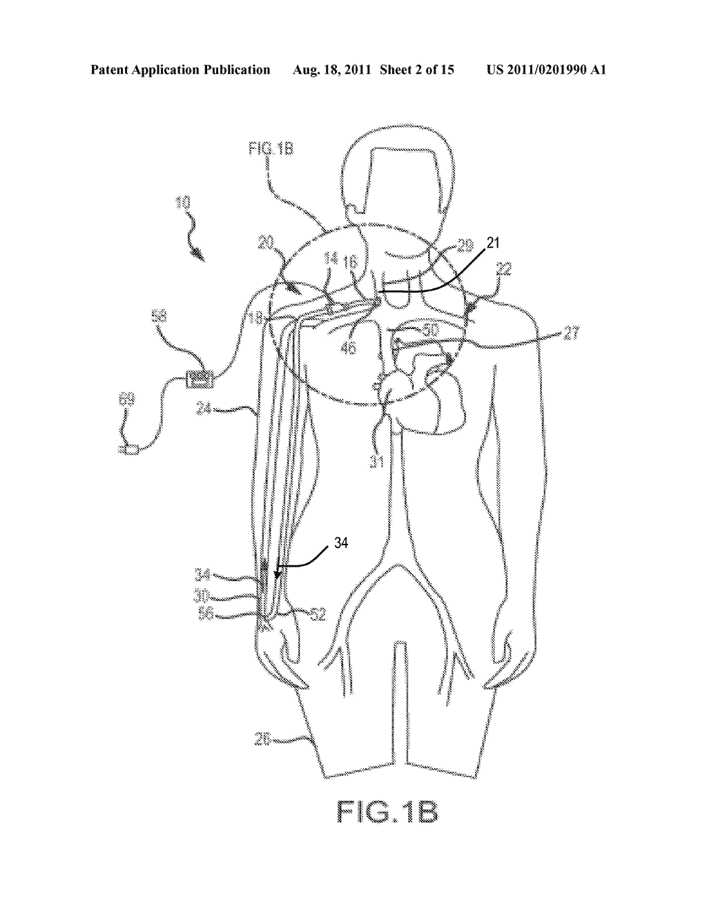 SYSTEM AND METHOD TO INCREASE THE OVERALL DIAMETER OF VEINS - diagram, schematic, and image 03