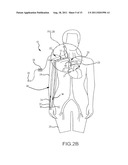 SYSTEM AND METHOD TO INCREASE THE OVERALL DIAMETER OF VEINS diagram and image