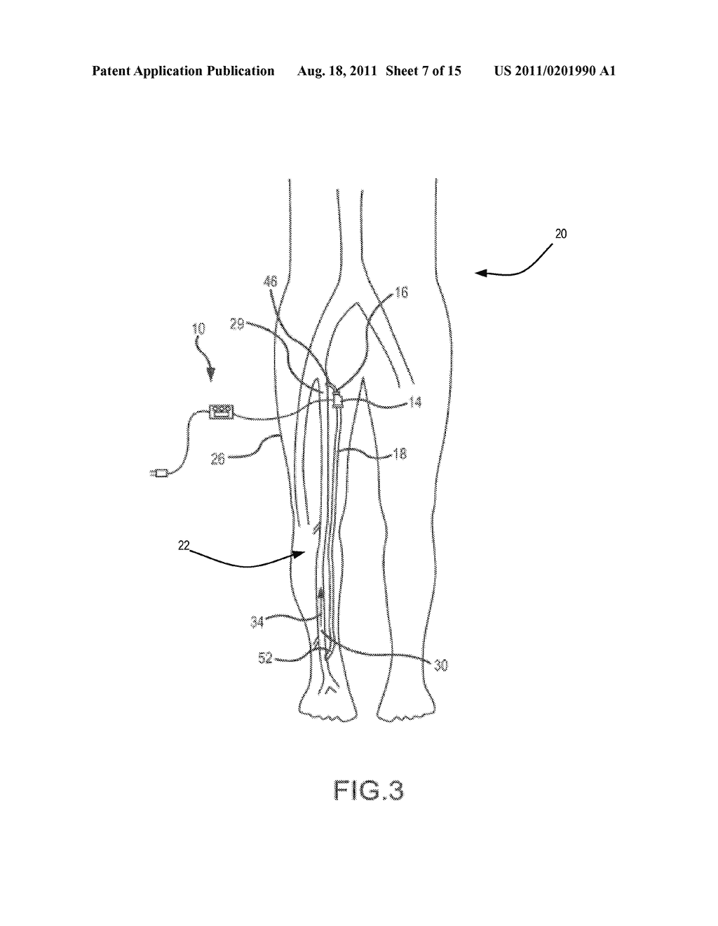 SYSTEM AND METHOD TO INCREASE THE OVERALL DIAMETER OF VEINS - diagram, schematic, and image 08