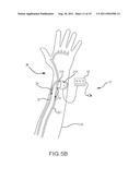 SYSTEM AND METHOD TO INCREASE THE OVERALL DIAMETER OF VEINS diagram and image