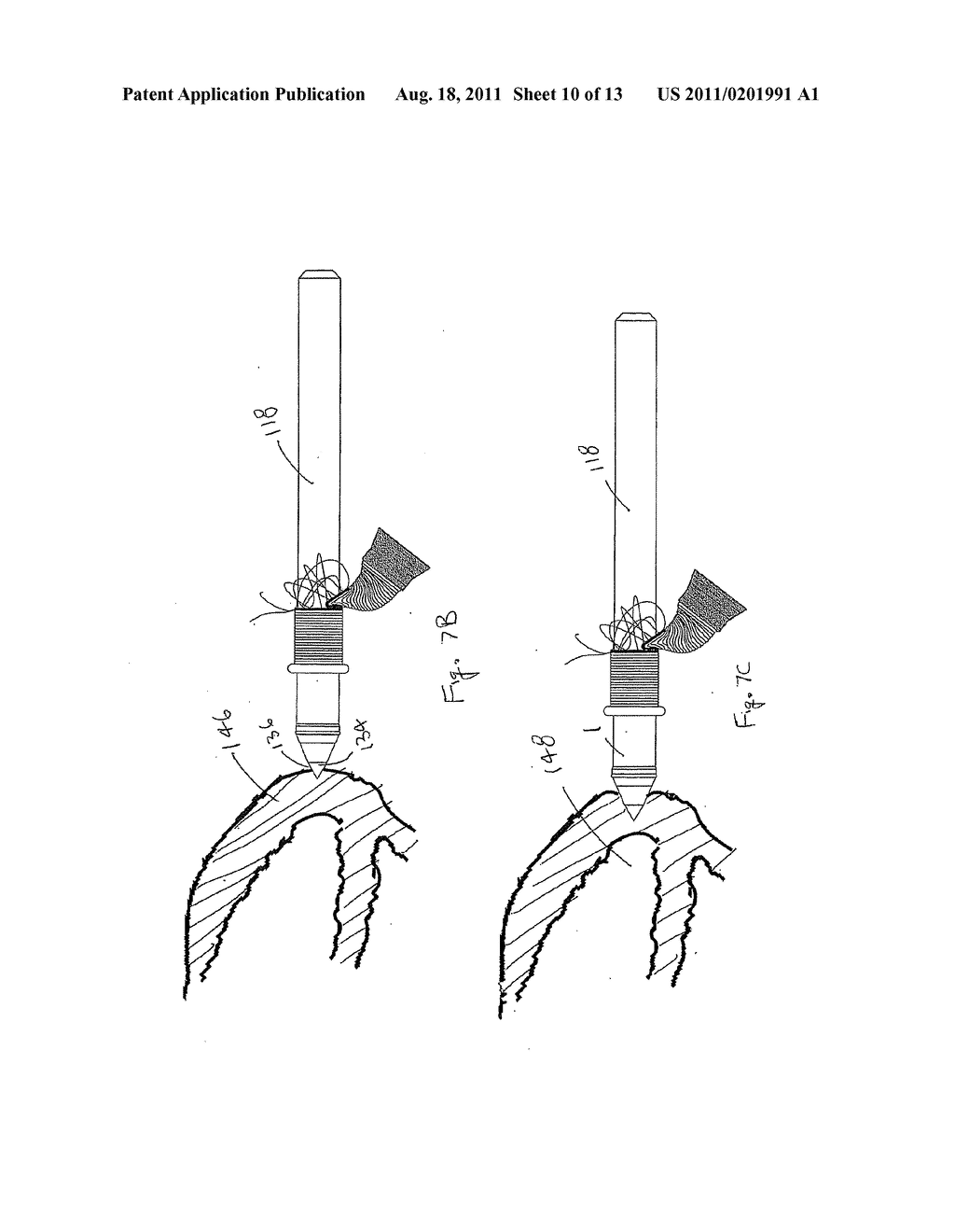 VALVE BYPASS GRAFT DEVICE, TOOLS, AND METHOD - diagram, schematic, and image 11