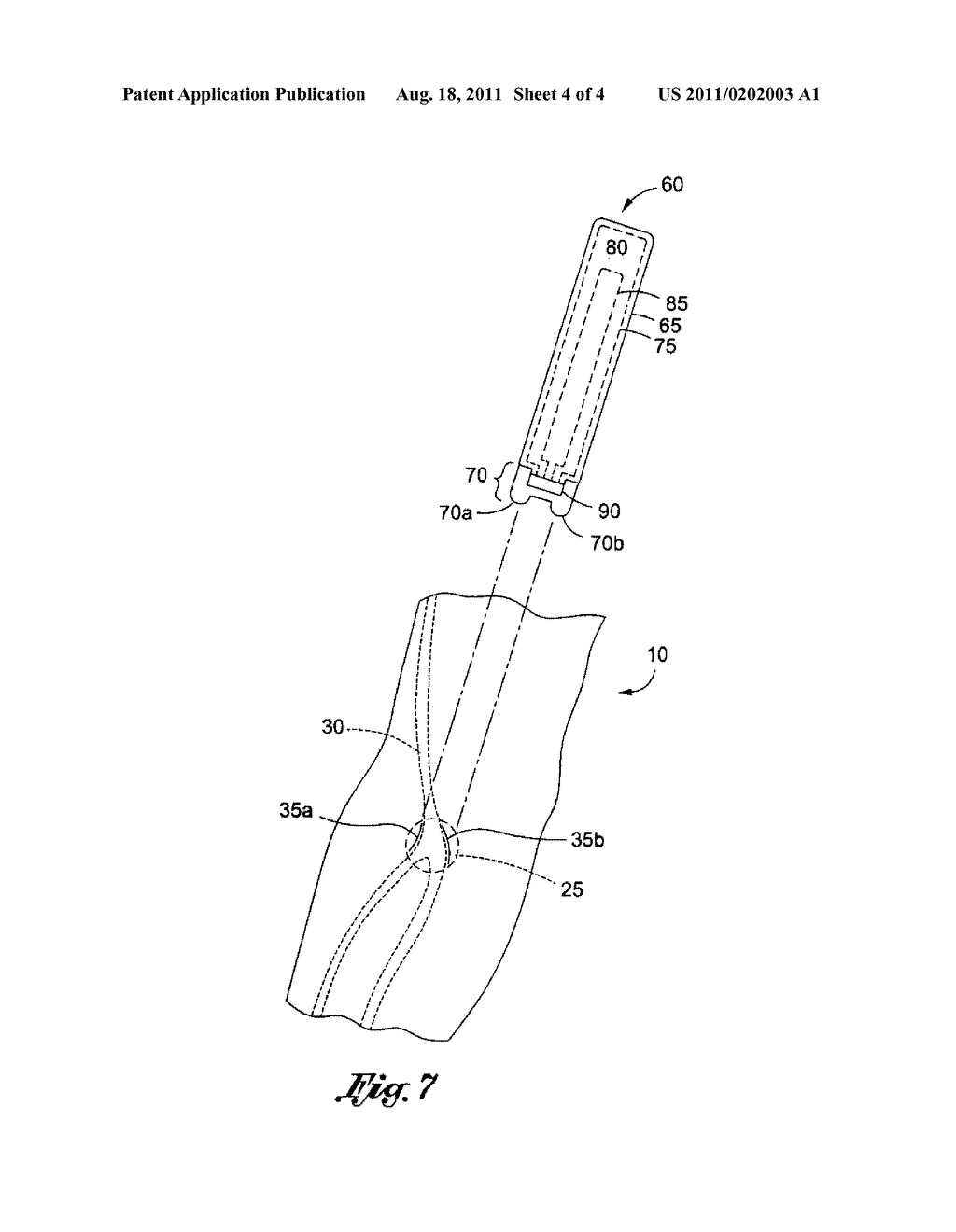 METHOD OF LOCATING VESSEL PUNCTURE ACCESS SITES VIA TATTOO OR PERMANENT     MARKING - diagram, schematic, and image 05