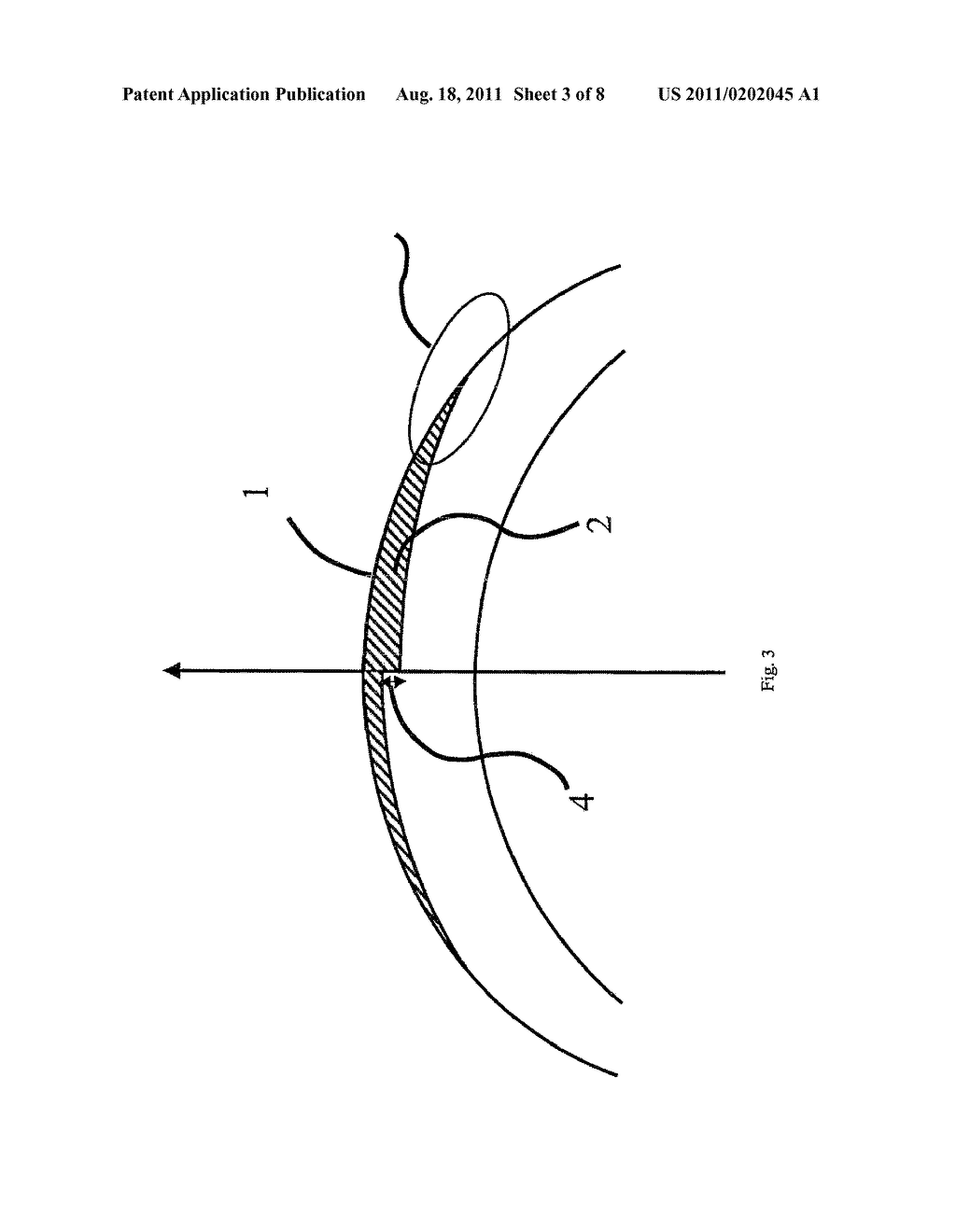 Combination of excimer laser ablation and femtosecond laser technology - diagram, schematic, and image 04