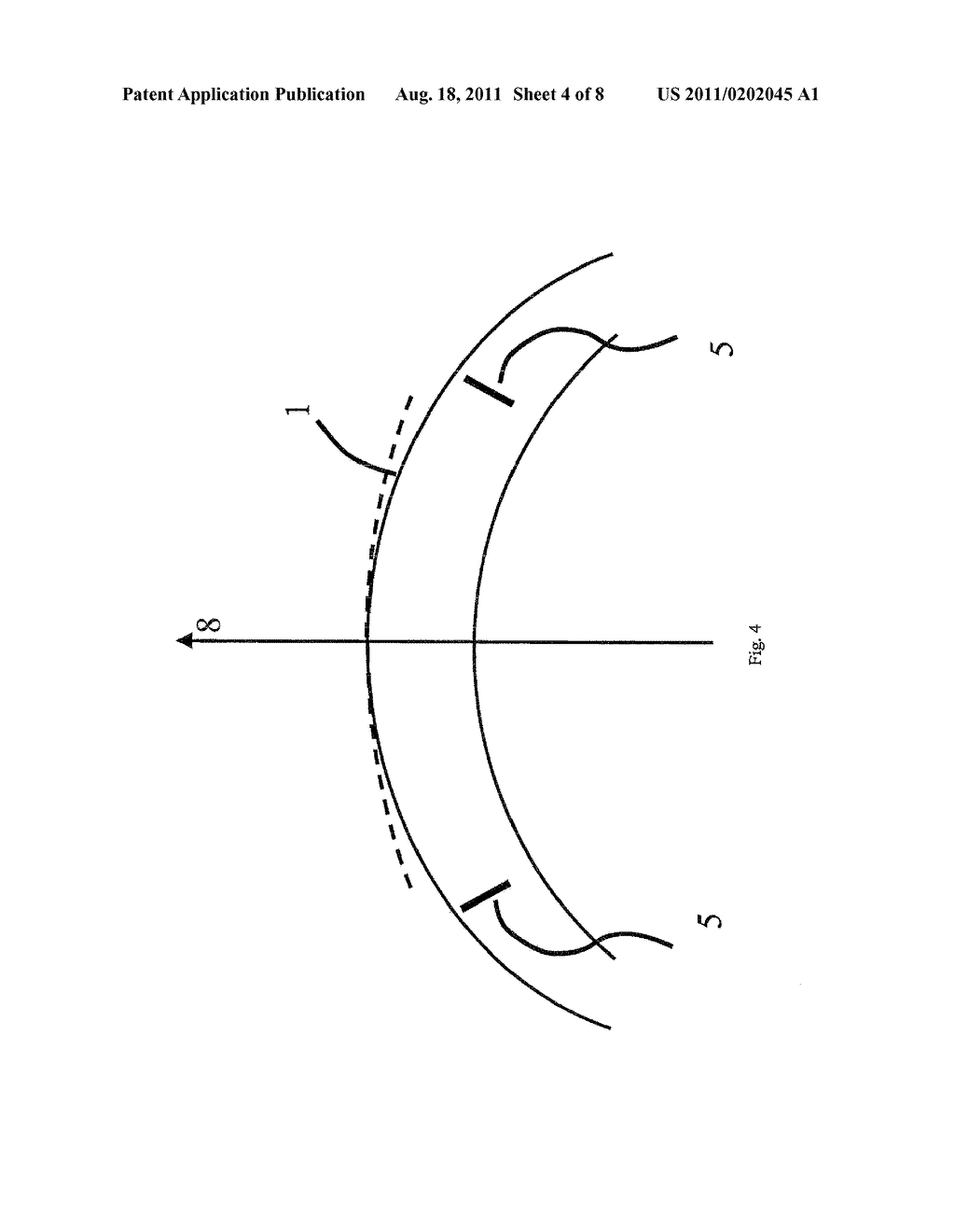 Combination of excimer laser ablation and femtosecond laser technology - diagram, schematic, and image 05