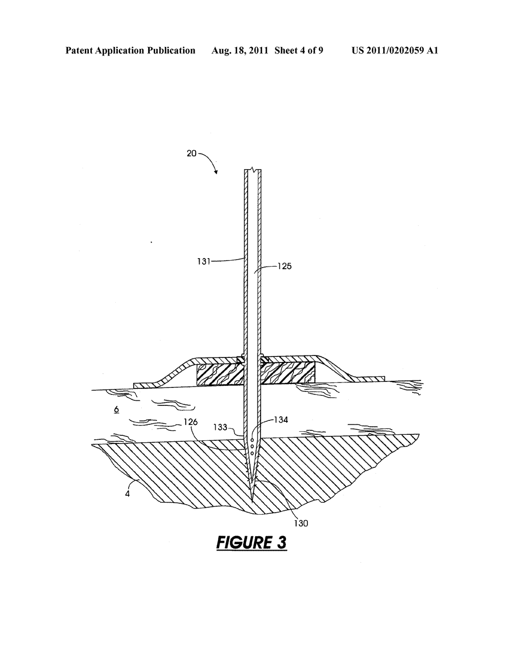 EXTERNAL FIXATION ASSEMBLY AND METHOD OF USE - diagram, schematic, and image 05