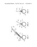 Temporary Anastomotic Seal and Method diagram and image