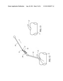 Temporary Anastomotic Seal and Method diagram and image