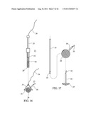 Temporary Anastomotic Seal and Method diagram and image