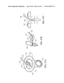 Temporary Anastomotic Seal and Method diagram and image