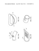 Temporary Anastomotic Seal and Method diagram and image