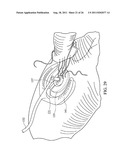 Temporary Anastomotic Seal and Method diagram and image