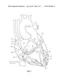 Operating A Vessel Occlusion Catheter diagram and image