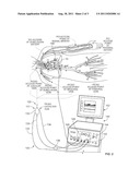 Operating A Vessel Occlusion Catheter diagram and image