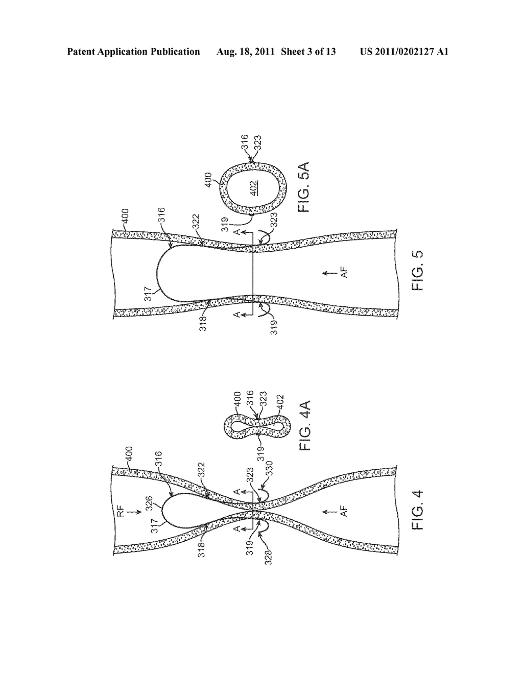 Apparatus and Methods for Creating a Venous Valve From Autologous Tissue - diagram, schematic, and image 04