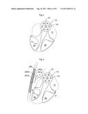 HEART HELP DEVICE, SYSTEM, AND METHOD diagram and image