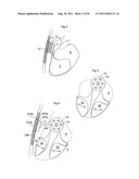 HEART HELP DEVICE, SYSTEM, AND METHOD diagram and image