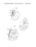 HEART HELP DEVICE, SYSTEM, AND METHOD diagram and image