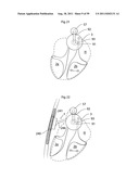 HEART HELP DEVICE, SYSTEM, AND METHOD diagram and image