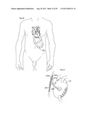 HEART HELP DEVICE, SYSTEM, AND METHOD diagram and image