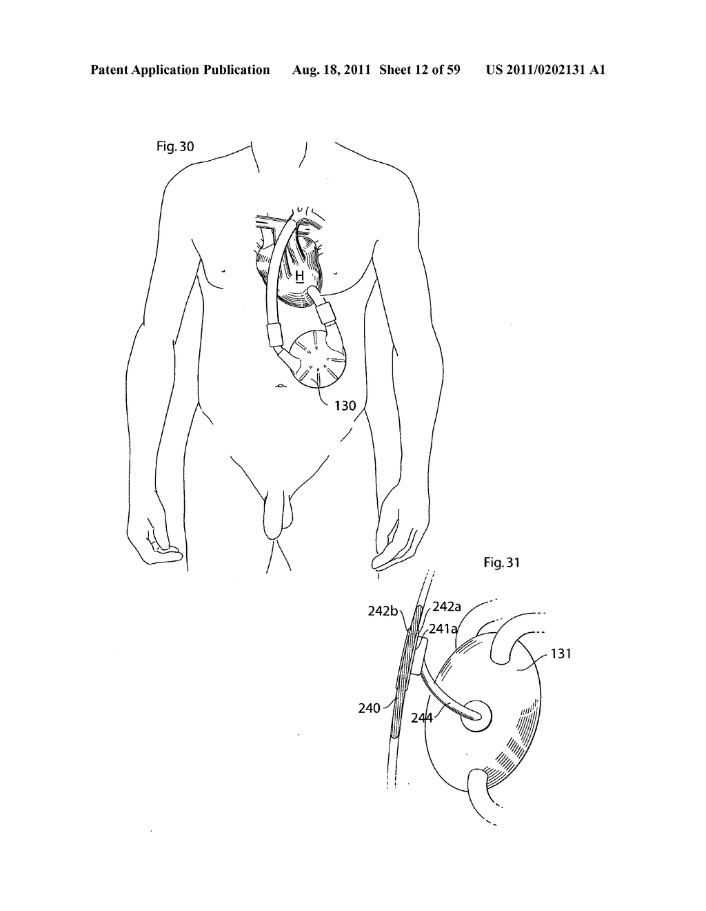 HEART HELP DEVICE, SYSTEM, AND METHOD - diagram, schematic, and image 13