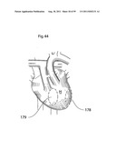 HEART HELP DEVICE, SYSTEM, AND METHOD diagram and image