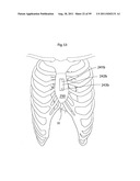 HEART HELP DEVICE, SYSTEM, AND METHOD diagram and image