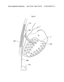 HEART HELP DEVICE, SYSTEM, AND METHOD diagram and image