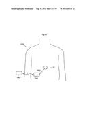 HEART HELP DEVICE, SYSTEM, AND METHOD diagram and image