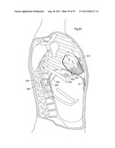 HEART HELP DEVICE, SYSTEM, AND METHOD diagram and image