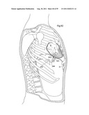 HEART HELP DEVICE, SYSTEM, AND METHOD diagram and image