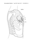 HEART HELP DEVICE, SYSTEM, AND METHOD diagram and image