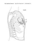 HEART HELP DEVICE, SYSTEM, AND METHOD diagram and image