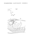 HEART HELP DEVICE, SYSTEM, AND METHOD diagram and image