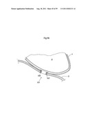 HEART HELP DEVICE, SYSTEM, AND METHOD diagram and image