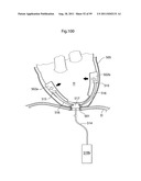 HEART HELP DEVICE, SYSTEM, AND METHOD diagram and image