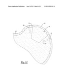 METHOD AND APPARATUS FOR AUGMENTING BONE DEFECTS diagram and image