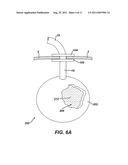 Methods and Devices for Treating Morbid Obesity Using Hydrogel diagram and image