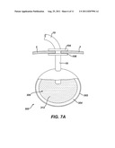 Methods and Devices for Treating Morbid Obesity Using Hydrogel diagram and image