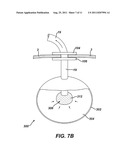 Methods and Devices for Treating Morbid Obesity Using Hydrogel diagram and image