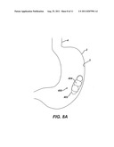 Methods and Devices for Treating Morbid Obesity Using Hydrogel diagram and image