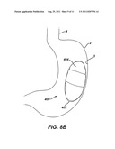 Methods and Devices for Treating Morbid Obesity Using Hydrogel diagram and image