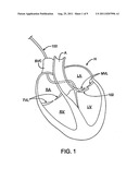 DEVICES AND METHODS FOR CARDIAC ANNULUS STABILIZATION AND TREATMENT diagram and image