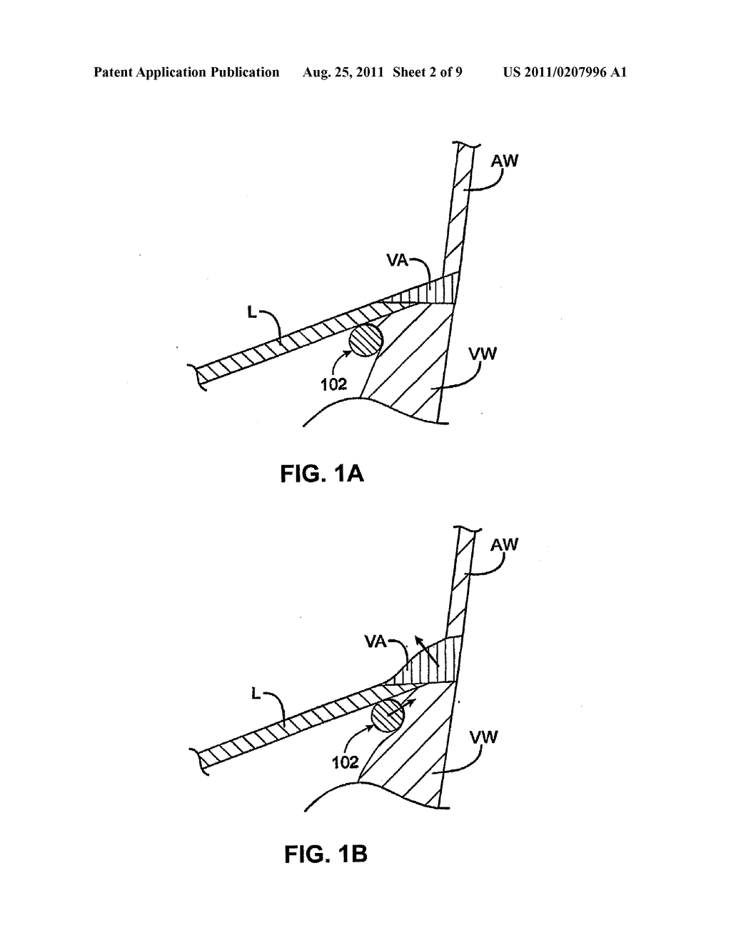 DEVICES AND METHODS FOR CARDIAC ANNULUS STABILIZATION AND TREATMENT - diagram, schematic, and image 03