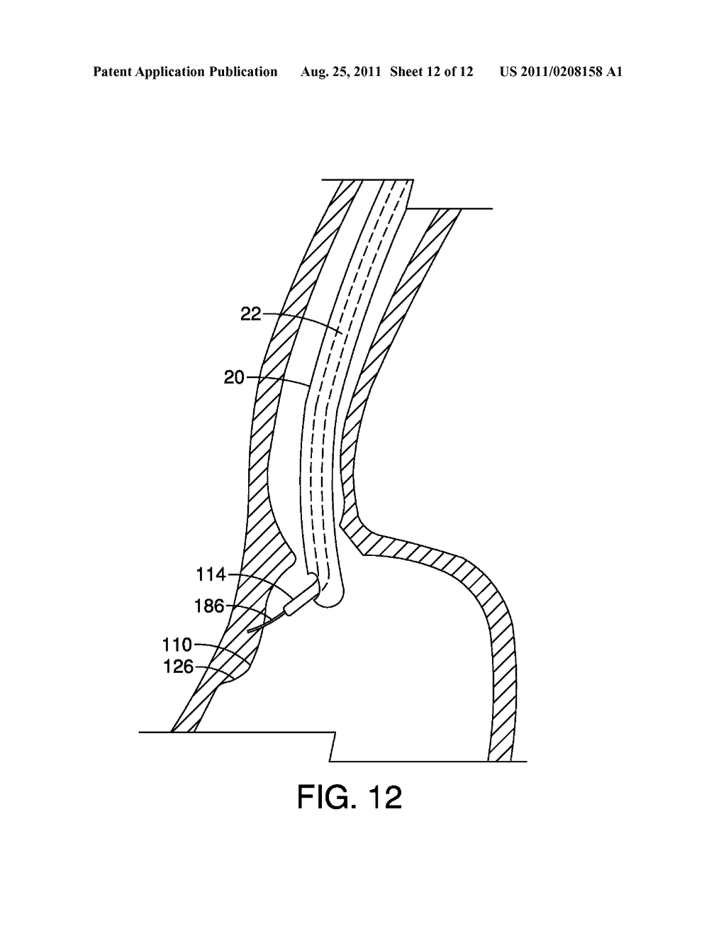 Apparatus and Method for Endoscopic Submucosal Dissection - diagram, schematic, and image 13