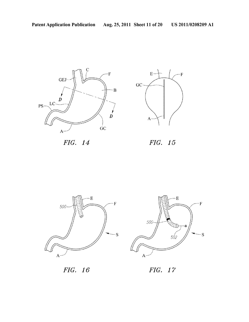 DEVICES AND METHODS FOR LAPAROSCOPIC GASTRIC TISSUE RECONFIGURATION - diagram, schematic, and image 12
