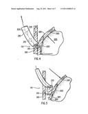 METHOD AND APPARATUS FOR ENDOSCOPIC REPAIR OF THE LOWER ESOPHAGEAL     SPHINCTER diagram and image