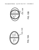 System and Method for the Treatment of Occluded Vessels diagram and image