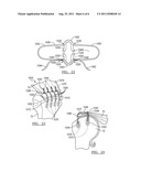 Method and Apparatus for Soft Tissue Fixation diagram and image