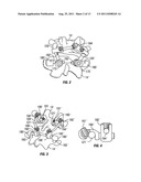 Arthroplasy Revision System and Method diagram and image